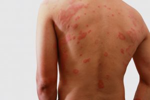 L'allergie cutanée peut prendre différentes formes