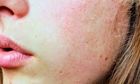 Une allergie cutanée est une réaction anormale du système immunitaire. D'où vient-elle ?