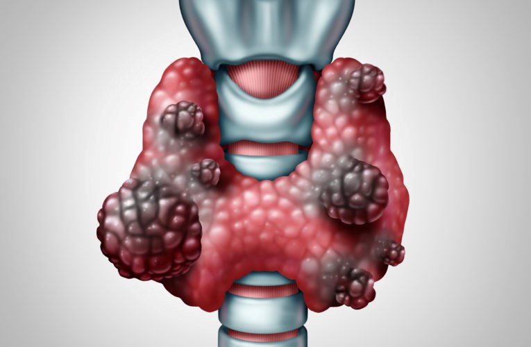L'hyperthyroïdie de la glande thyroïde n'est pas la même dans tous les cas.